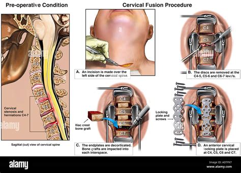 Spine Surgery C5-6 Disc Herniation With Cervical Discectomy, 53% OFF