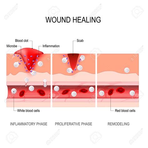 wound healing process. Tissue injury and inflammation. | Sports Physio Massage Gold Coast ...