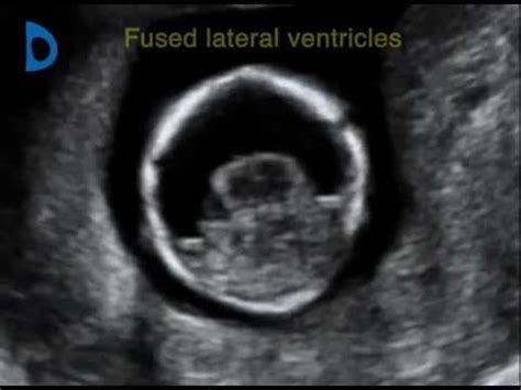 Fetal Medicine Foundation - alobar holoprosencephaly 12 weeks - YouTube