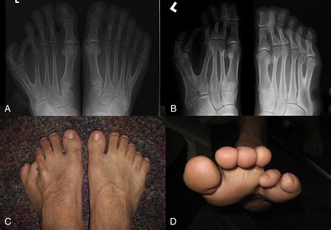 Correction of Postaxial Metatarsal Polydactyly of the Foot by Percutaneous Ray Amputation and ...