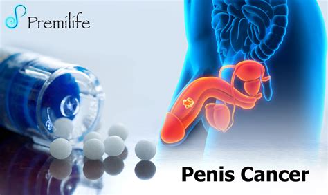 Penis Cancer | Premilife - Homeopathic Remedies