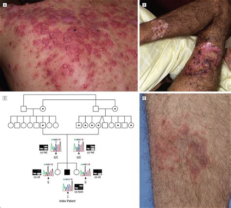 Identification of a Homozygous PSTPIP1 Mutation in a Patient With a PAPA-Like Syndrome ...