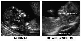 Nuchal Translucency (NT) Normal Range | New Health Advisor