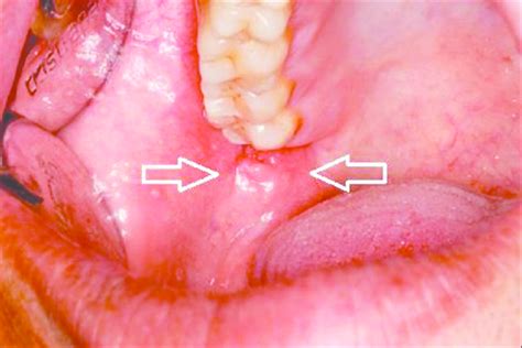 Retromolar Trigone Anatomy