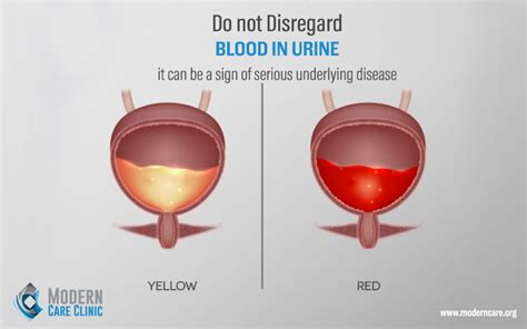 Blood In Urine! | Modern Care Clinic