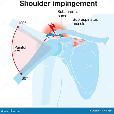 Shoulder Impingement Syndrome Royalty-Free Stock Photography ...