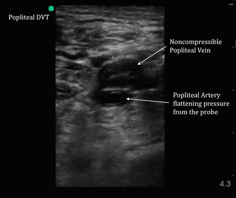 Blood Clot In Leg Ultrasound