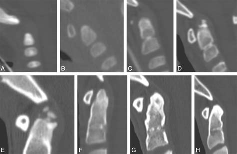 Normal Ossification Patterns of Atlas and Axis: A CT Study | American Journal of Neuroradiology