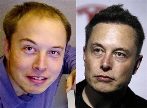 What would Elon Musk look like without the hair transplant? : r/PhotoshopRequest