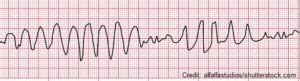 Ventricular Tachycardia (V-tach) ECG/EKG Review Nursing