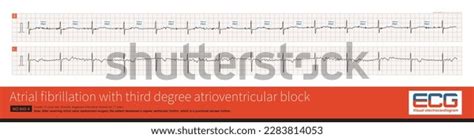 Cardiac Surgery One Common Causes Iatrogenic Stock Illustration ...