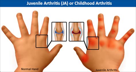 Ayurvedic Treatment of Childhood Arthritis – Ayurveda Wonder