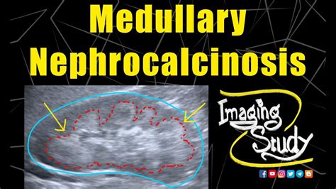 Medullary Nephrocalcinosis || Ultrasound || Case 128 - YouTube