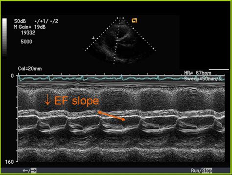 Mitral stenosis echocardiography - wikidoc