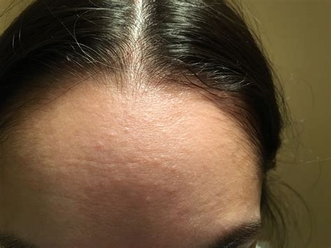 Small forehead bumps that won't go away - General acne discussion - by ...