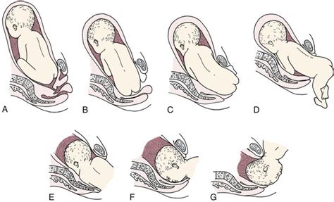 Labor and Birth Complications | Nurse Key