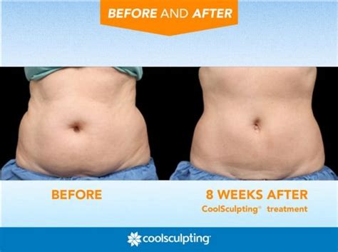 CoolSculpting Fat Freezing Procedure | ME Aesthetic Clinic Malaysia