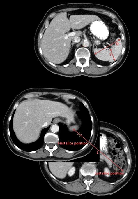 Estimate of spleen volume on CT or MRI, splenic index - calculator | Classifications, online ...