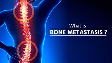 What is bone metastasis | Stage 4 Cancer | Bone Metastasis | How Cancer Spreads | metastasis ...