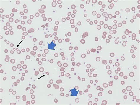 Iron Deficiency Anemia • The Blood Project