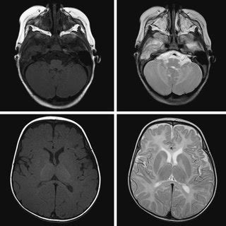 (PDF) Clinical Pictures in Pelizaeus-Merzbacher Disease: A Report of a Case