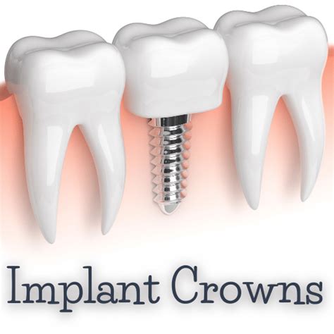 Dental Implant Cost in South Bay Area | Save 30% Promotion