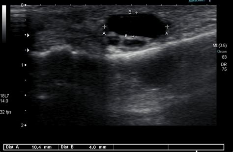 Adventitial (Adventitious) Bursa - Ankle, Foot and Orthotic Centre