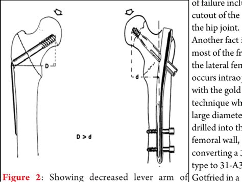 [PDF] Intramedullary Nail Versus Dynamic Hip Screw ; Intramedullary Nail ( Advantages And ...