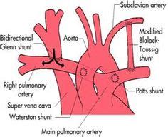 23 B-T Shunt ideas | stenosis, pulmonary, arteries