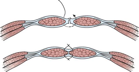 General Laparotomy | Basicmedical Key