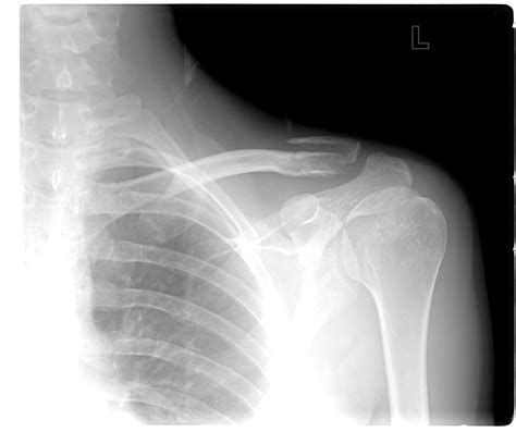 "High Left Clavicle Fracture, Surgery Required? (X-Rays Included ...