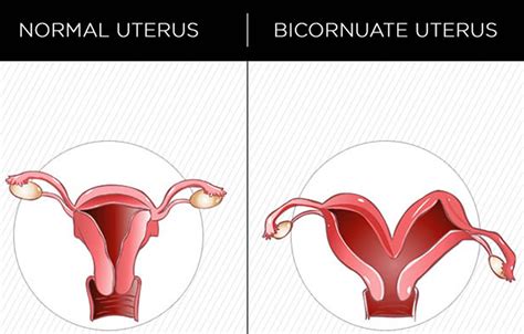 Bicornuate Uterus - Causes, Symptoms, Ultrasound, Fertility & Pregnancy