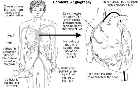 Coronary Angiography. Medical investigation into angina | Patient