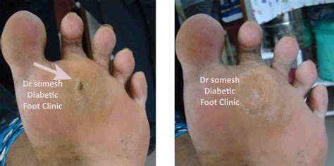 Diabetic Foot Ulcer Stages 2nd MTP region - Podiatry Doctor