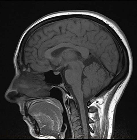 MRI Brain Scan - Diagnostic Imaging - Melbourne Radiology