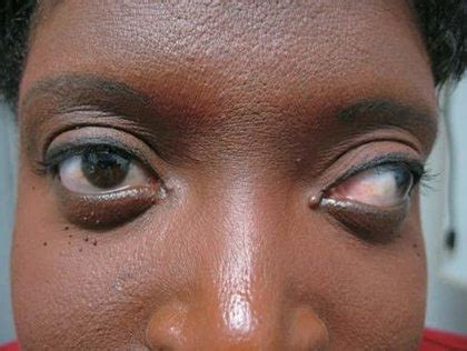 What Is Strabismus,Causes,Treatment And Cure - Notes Read