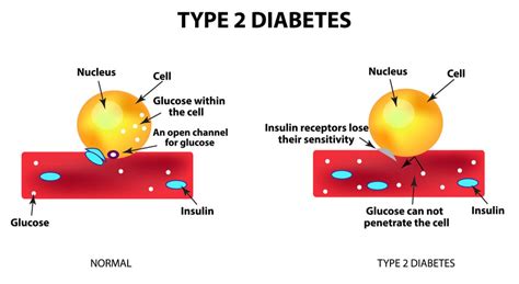 Diabetes Type II - Sutton Place Dental Associates