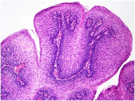 Esophageal Squamous Papilloma Esophagus Benign Squamous Papilloma | The ...