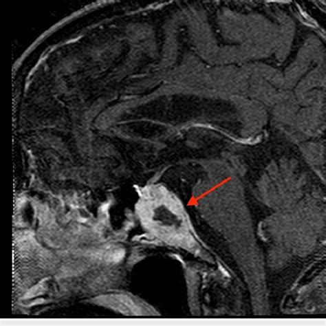 Sagittal MRI of the metastatic lesion abutting the optic chiasm (arrow). | Download Scientific ...