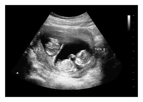 20 Weeks | Fake Ultrasound w/ Instant Download!