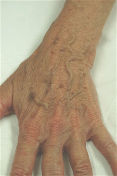 Which Procedures Are Used for Hand Rejuvenation?