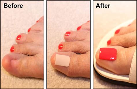 Innovative Solution: Conceal a Damaged or Missing Toenail