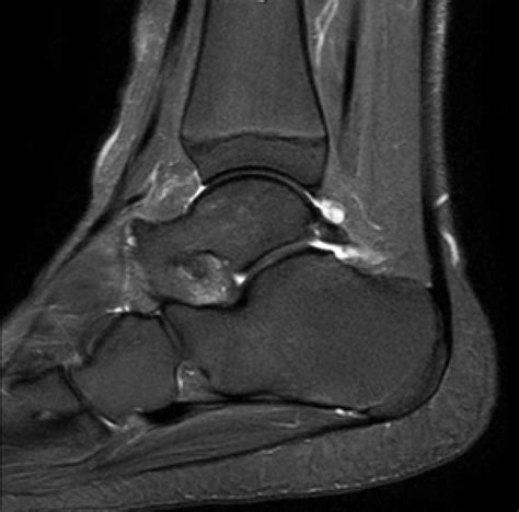 Posterior Ankle Impingement Mri