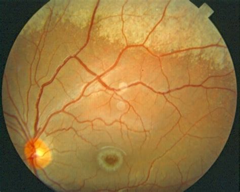 Niemann Pick Disease Type B - Retina Image Bank