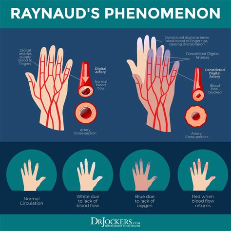 Raynaud's Phenomenon: Causes, Symptoms and Support Strategies