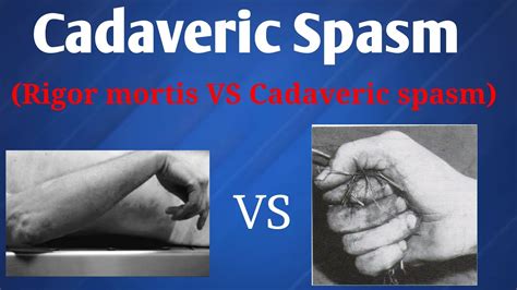 Cadaveric spasm | Difference between Rigor mortis & Cadaveric spasm - YouTube