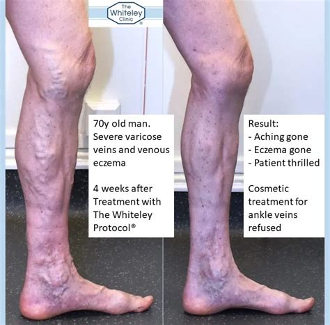 List 93+ Pictures Varicose Veins Images Legs Updated