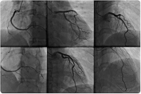 Angiogram