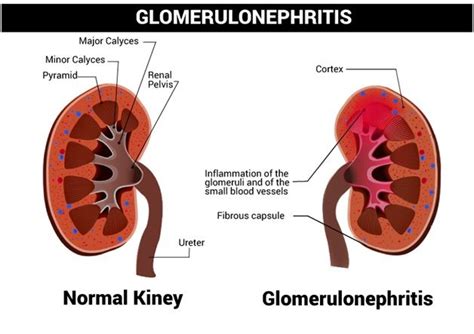 Glomerulonephritis Types