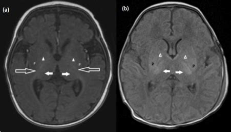 Pediatric MRI Brain: Normal or abnormal, that is the question.